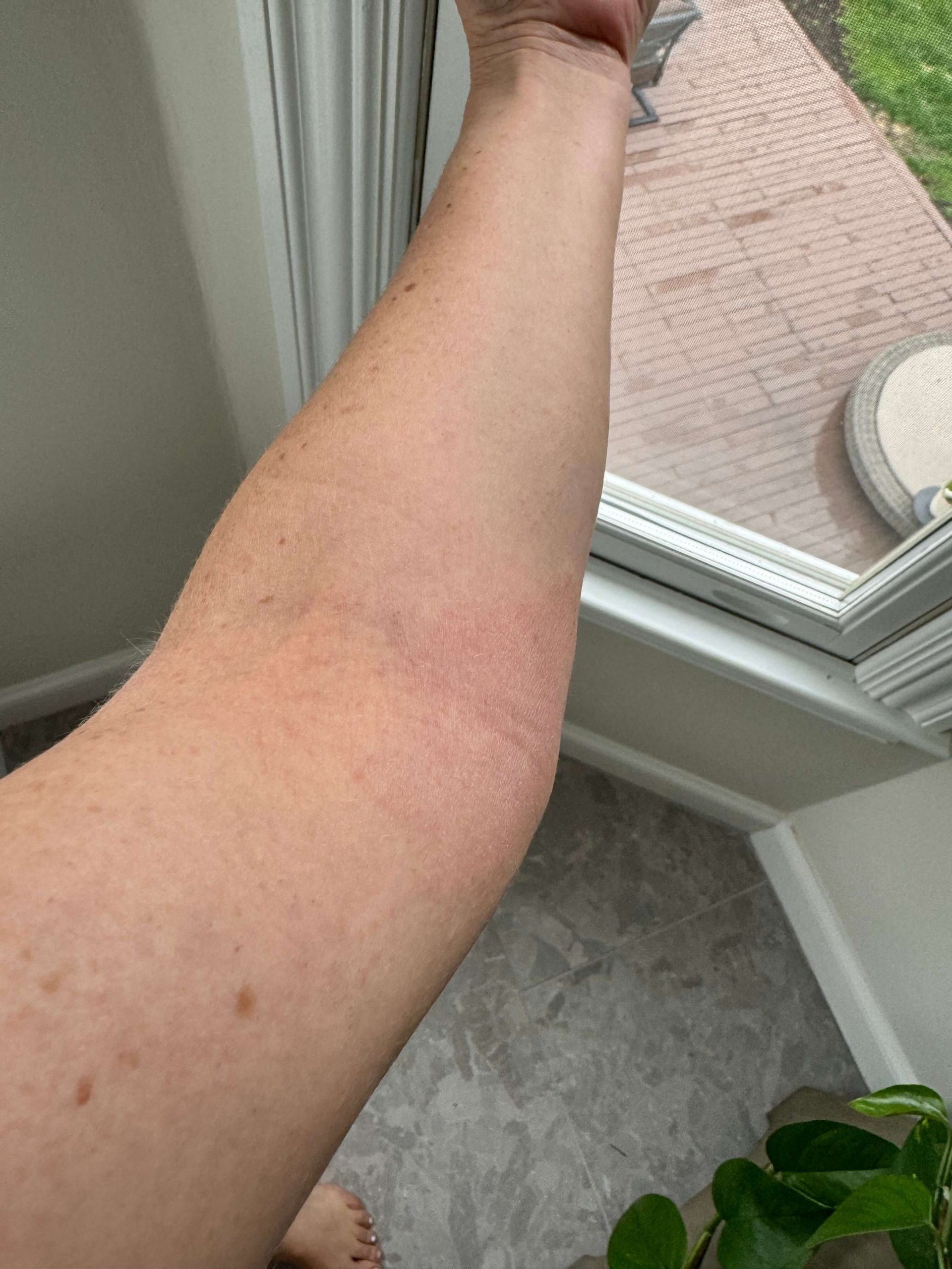  faded red mark on inner elbow 